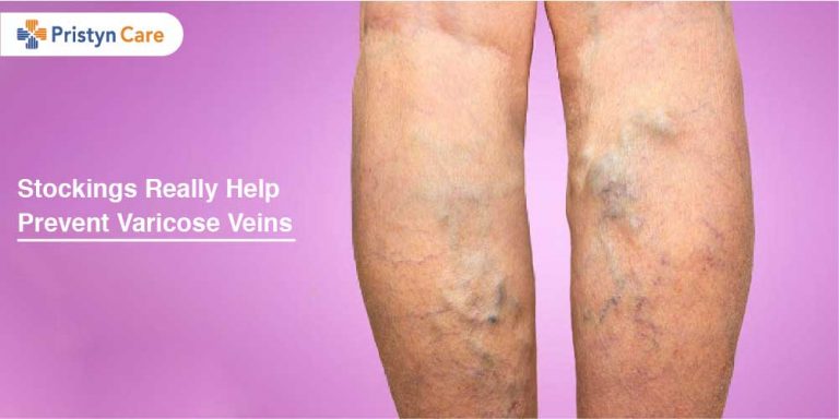 Stockings Really Help Prevent Varicose Veins