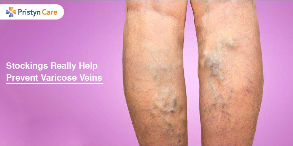 Stockings Really Help Prevent Varicose Veins