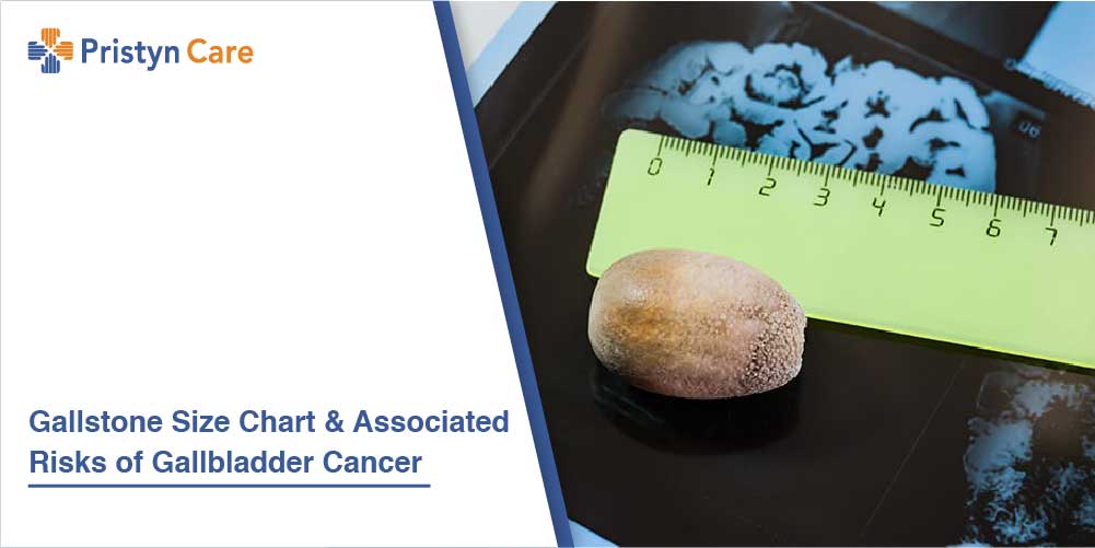 Gallstone Size Chart And Associated Risks Of Gallbladder Cancer gallstone-size-chart-and-associated-risks-of-gallbladder-cancer
