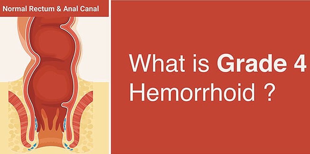 What is grade 4 hemorrhoid