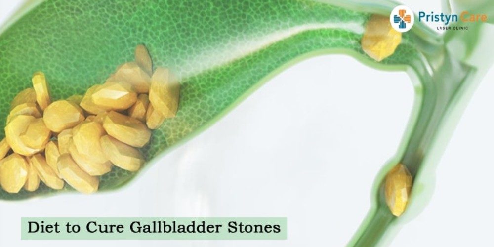 diet-to-cure-gallbladder-stones-min