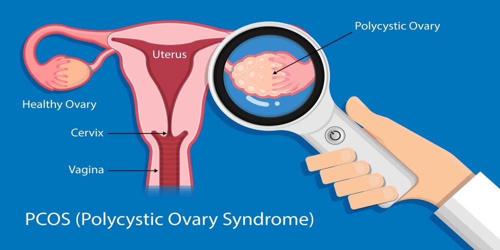 PCOS- Hội chứng buồng trứng đa nang