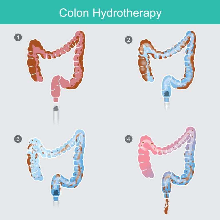 Colon Hydrotherapy for an Improved Health