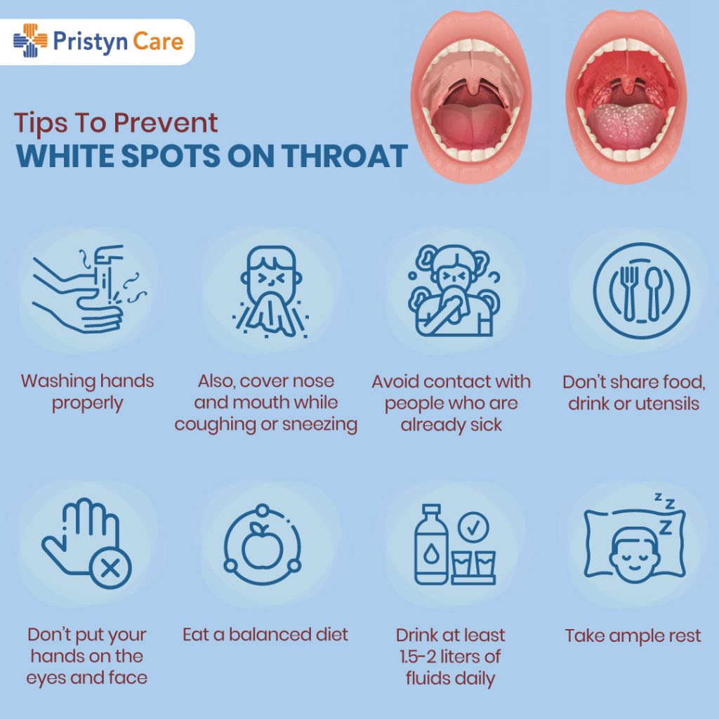 A Must Read For White Spots on the Throat: Doctor's Advice