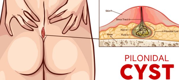 16 Effective Home Remedies For Pilonidal Cyst