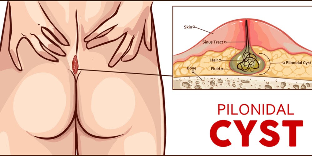 16 Effective Home Remedies For Pilonidal Cyst By PristynCare