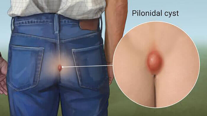 man suffering from pilonidal cyst