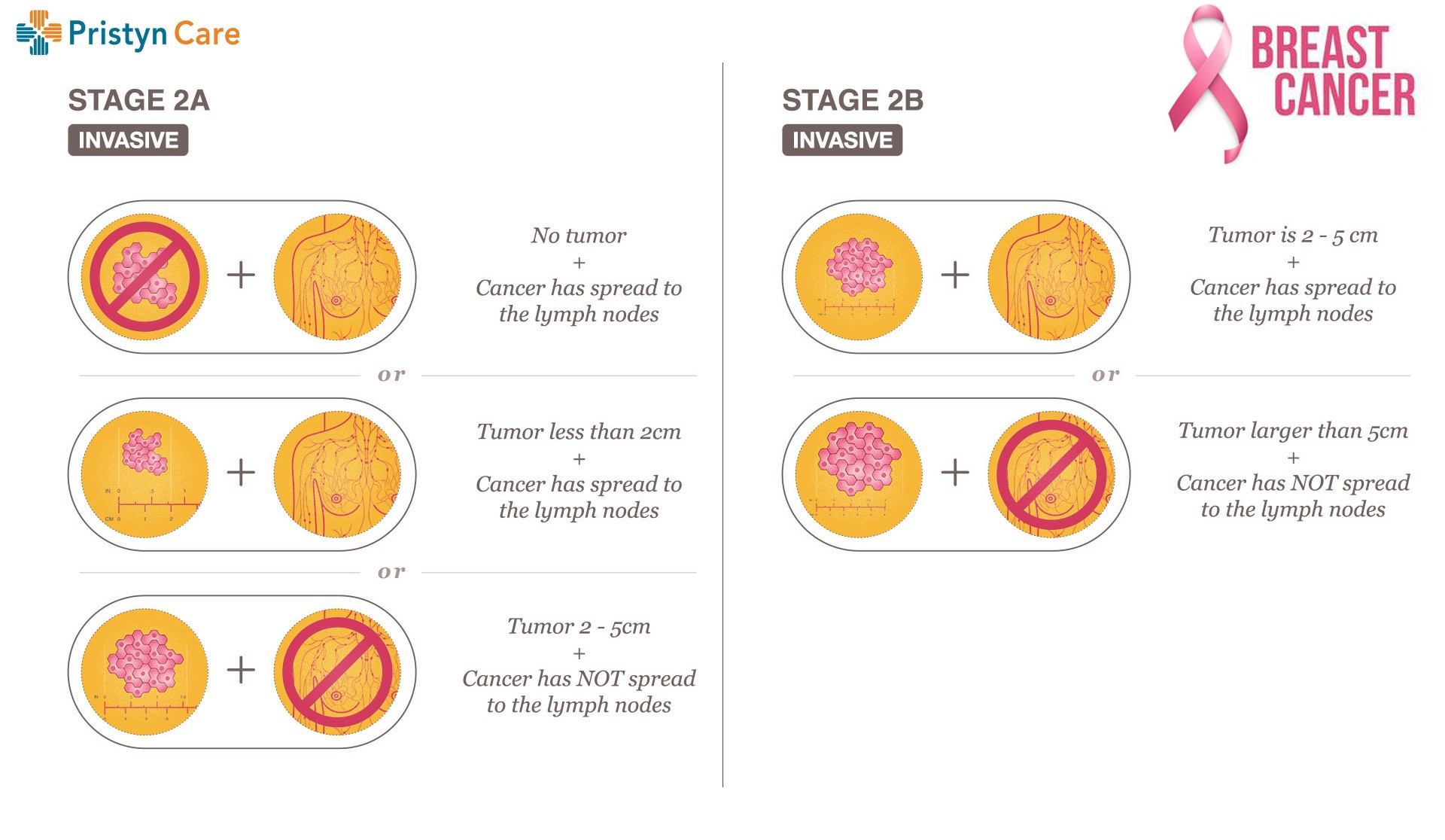 Tnm Staging System For Breast Cancer Pristyn Care