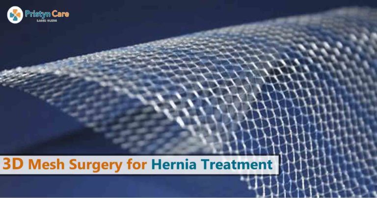 3d mesh surgery for hernia treatment