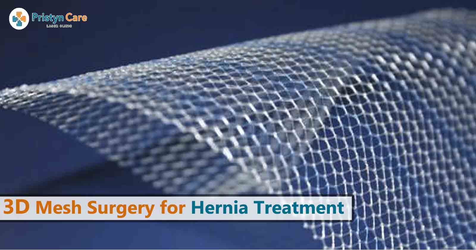 3d mesh surgery for hernia treatment