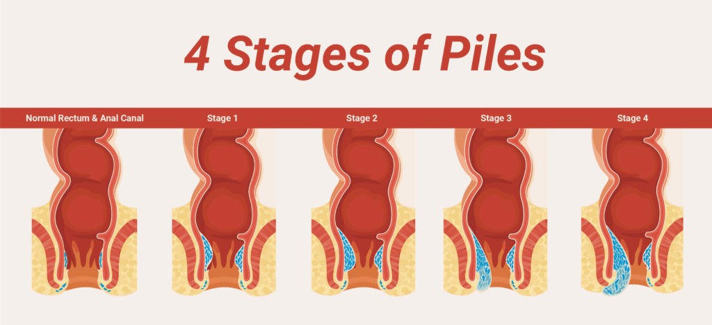 4 stages of piles