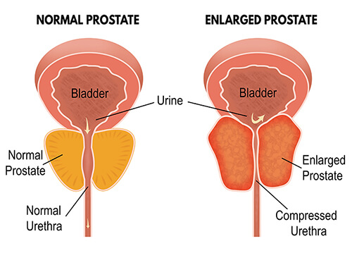 normal prostate vs enlarged prostate