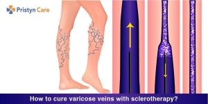 How to cure varicose veins with sclerotherapy?