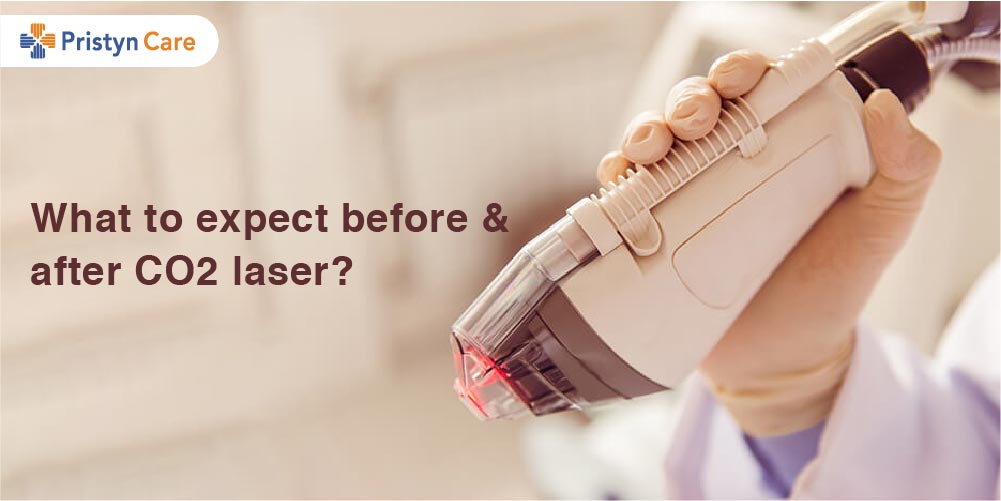 What to expect before and after CO2 laser