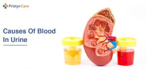 Blood In Urine
