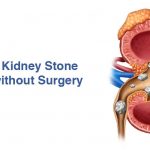 10 Ways for Kidney Stone Treatment without Surgery