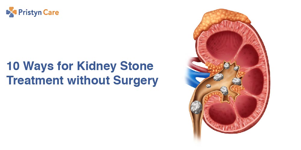10 Ways for Kidney Stone Treatment without Surgery