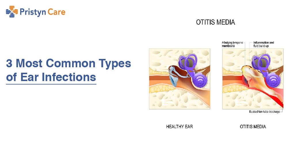 3 Most Common Types of Ear Infections (Otitis Media)