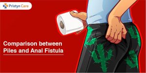 Comparison between Piles and Anal Fistula