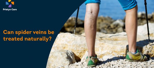 Can spider veins be treated naturally?