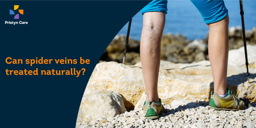 Can spider veins be treated naturally?
