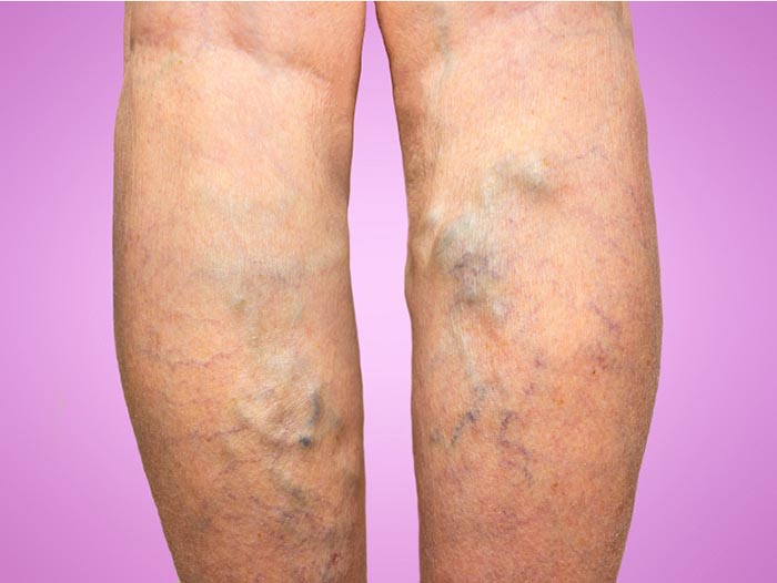varicose veins in legs during pregnancy