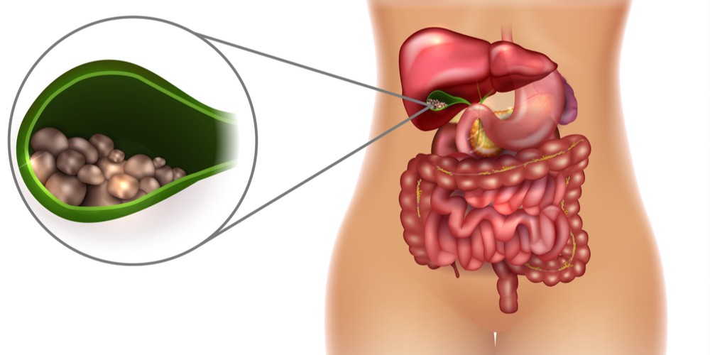 Gallbladder stone