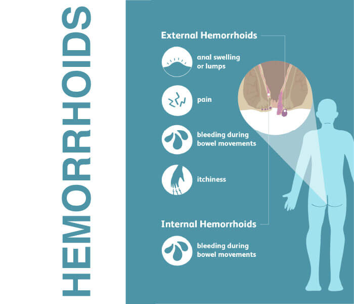 symptoms of hemorrhoids