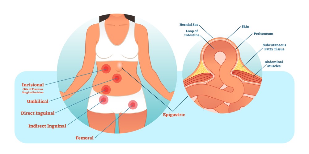 common types of hernias