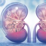 How To Treat Kidney Stone During Pregnancy