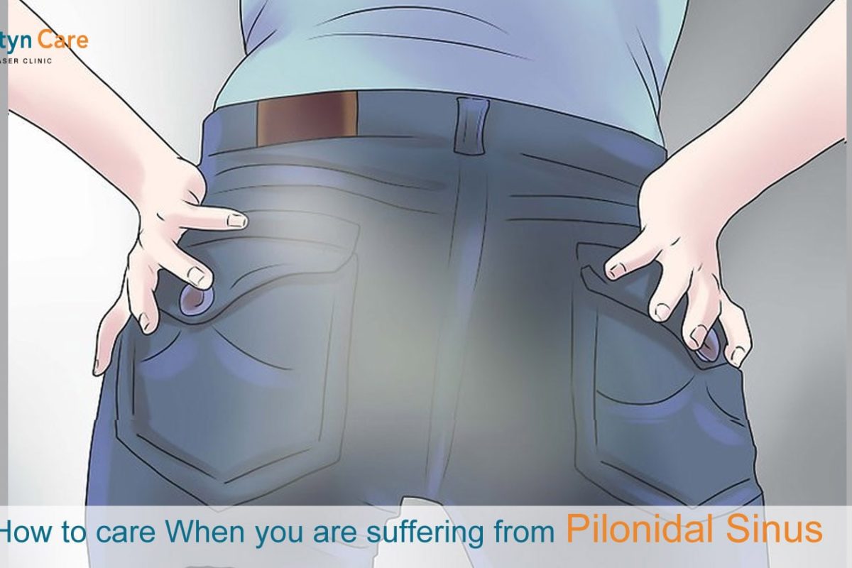 How to care when you are suffering from Pilonidal Sinus