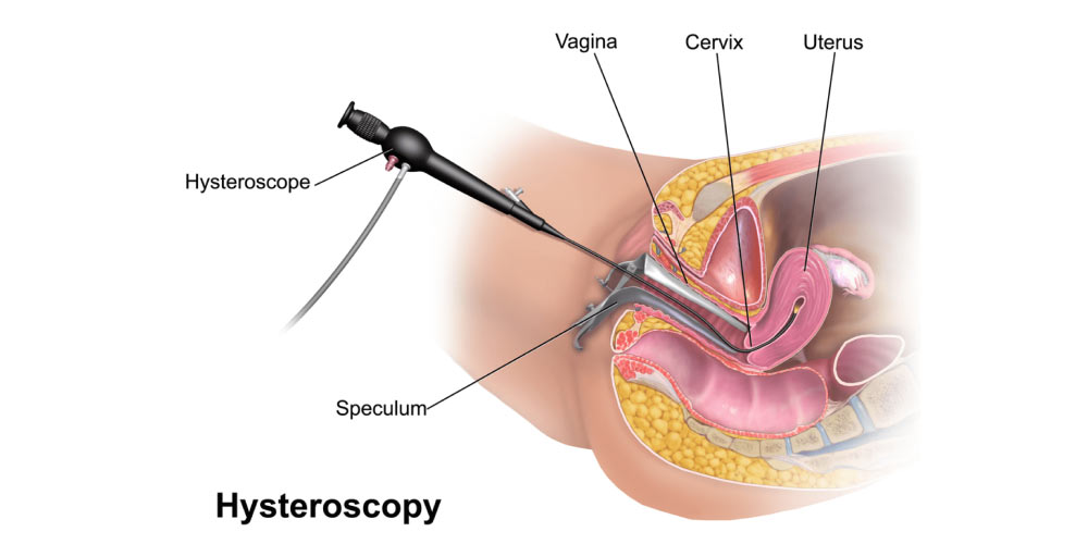 Hysteroscopy procedure