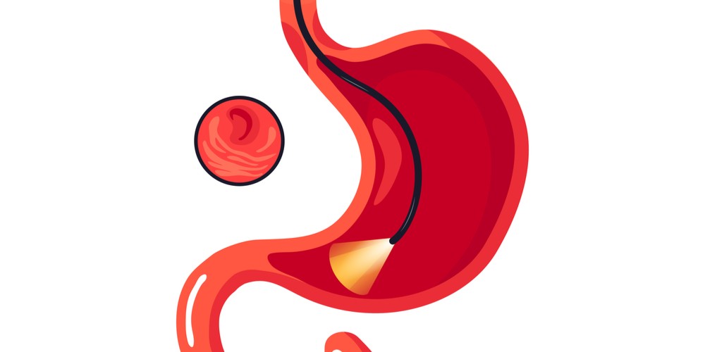 Know Procedure of Endoscopy Test and Cost