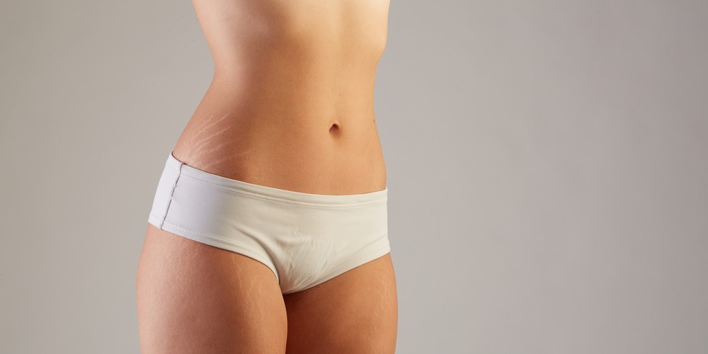 Let’s Gather Some Facts About STRETCH MARKS