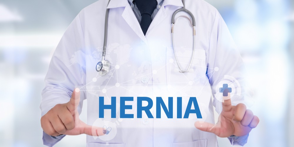Role of Laparoscopy to Treat Hernia Effectively
