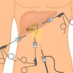 Step wise pictorial representation of Gall Bladder Surgery