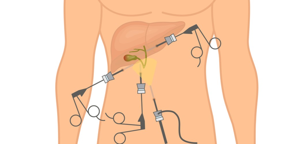 Step wise pictorial representation of Gall Bladder Surgery
