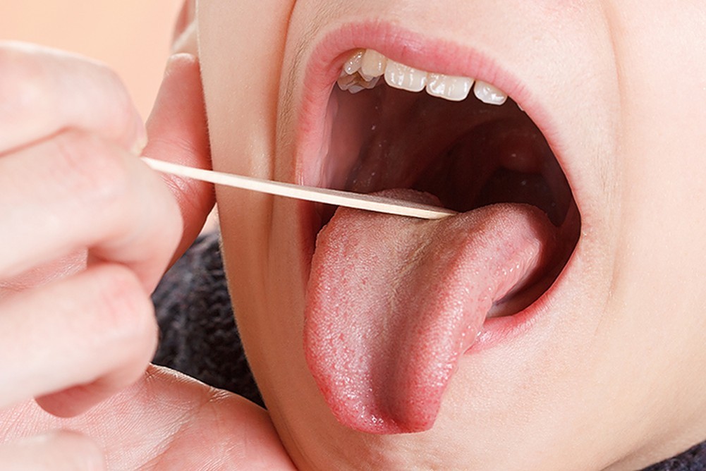 Tonsillectomy-A-compete-guide