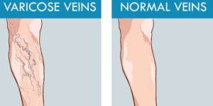 Top 10 ways to prevent varicose veins
