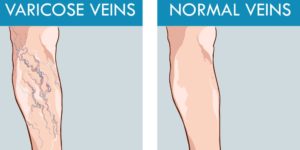 picături din venele varicoase cu castan tratamentul venelor varicoase în asistență medicală