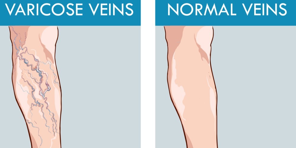 Top 10 ways to prevent varicose veins - Pristyn Care