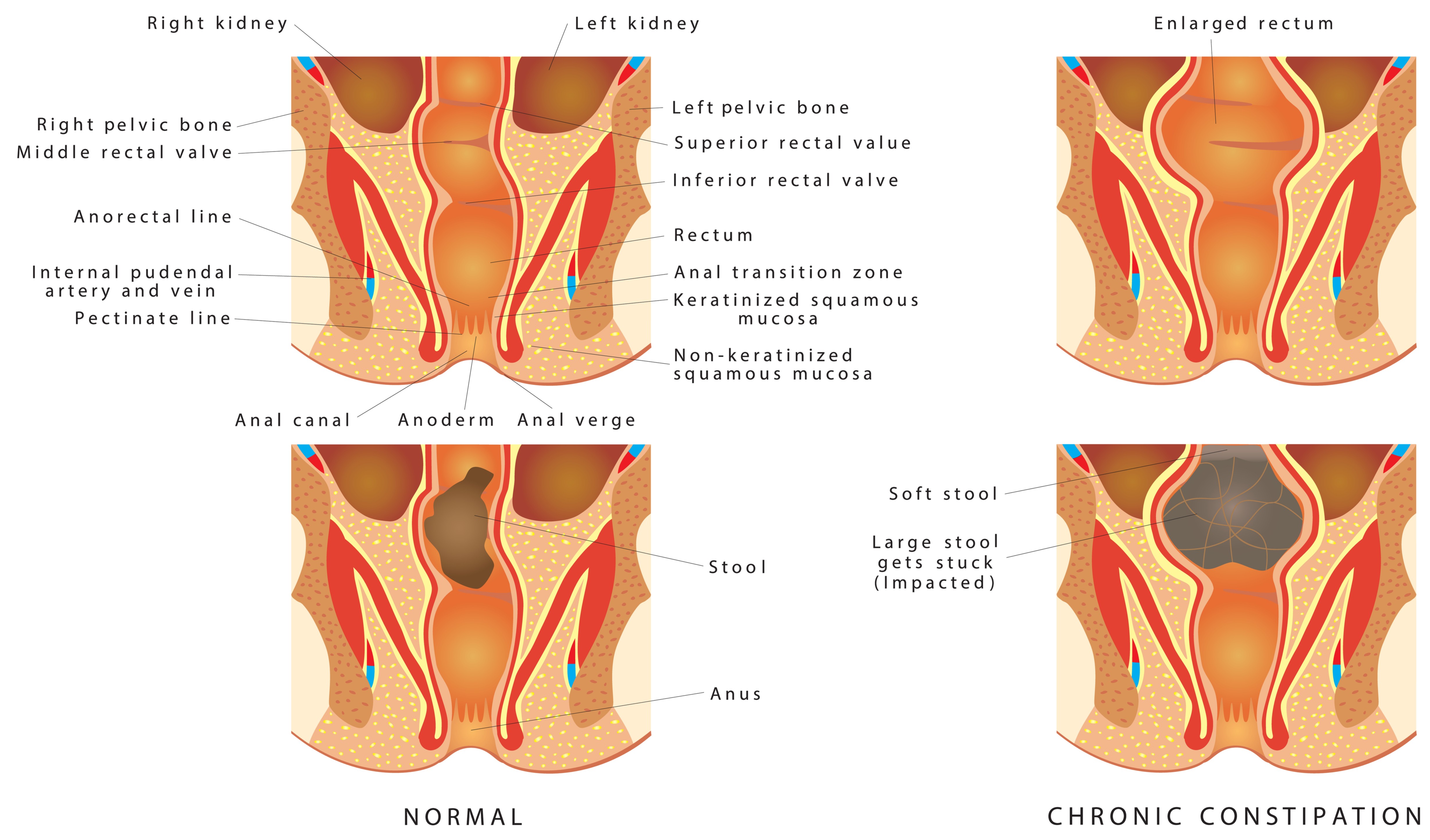 Types Of Constipation