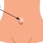 Umbilical hernia in adults and other Related Problems