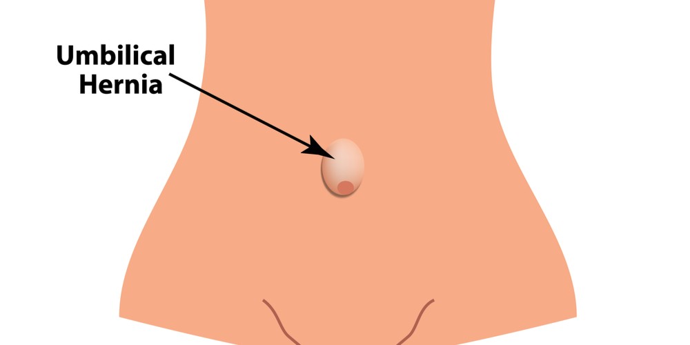 Umbilical hernia in adults and other Related Problems