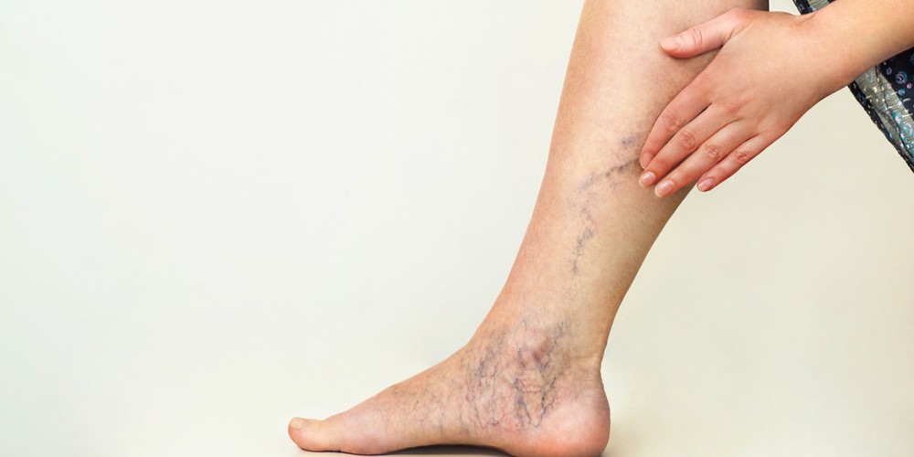 Varicose Veins Proven Treatments