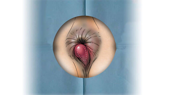 thrombosed hemorrhoids