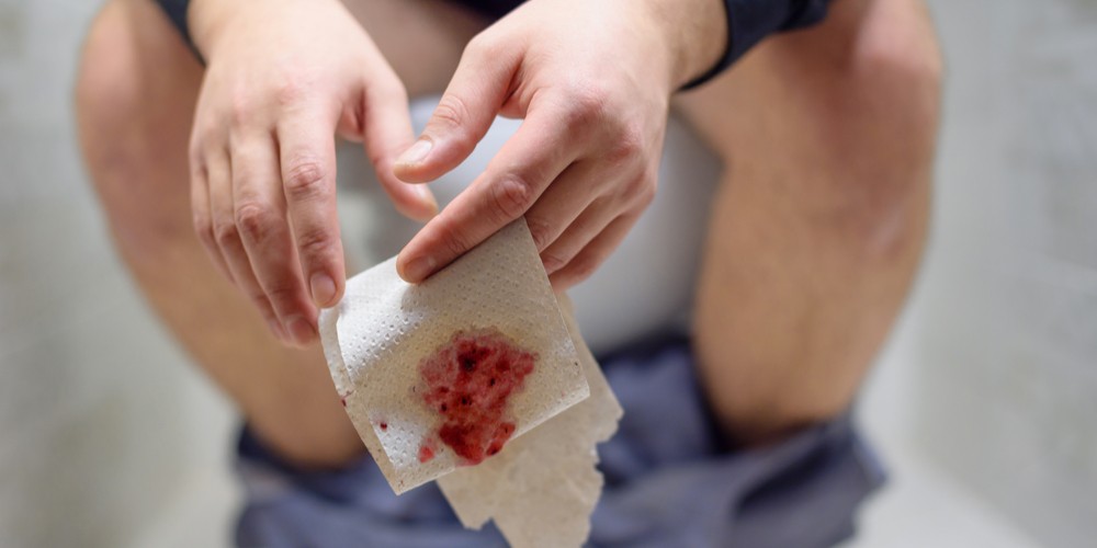 Blood in stool: 15 Reasons for Cause of Blood in Stool