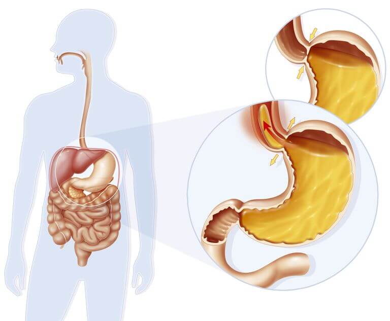 achalasia disorders