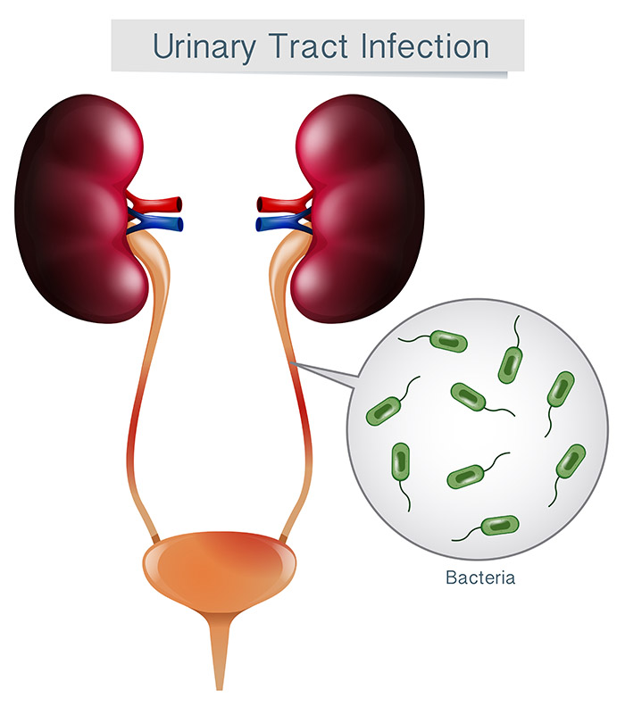 urinary tract infections