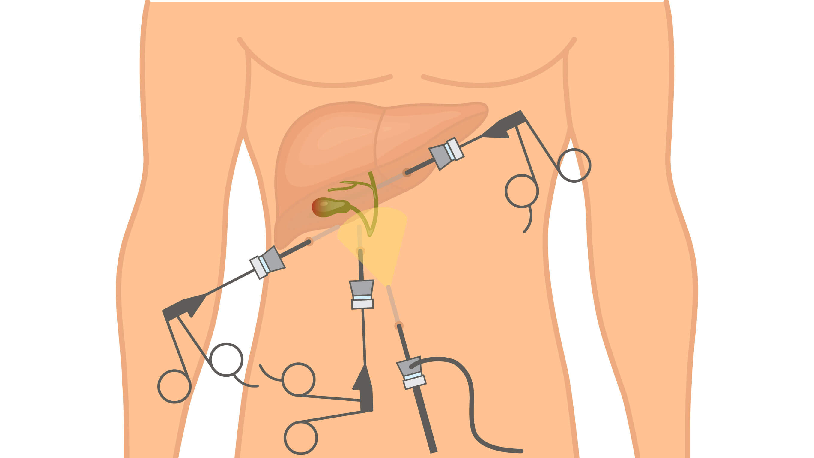 representation of gall bladder surgery